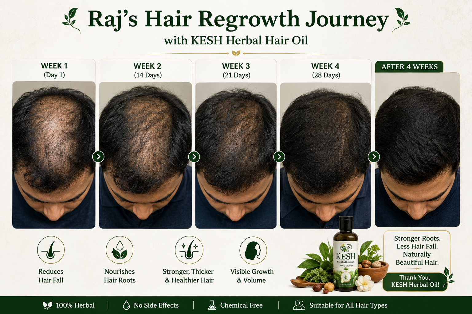 Raj's hair regrowth with KESH Herbal Hair Oil - Before and After